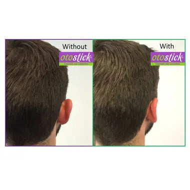 Otostick Aesthetic Ear Concealer for Normal Skin