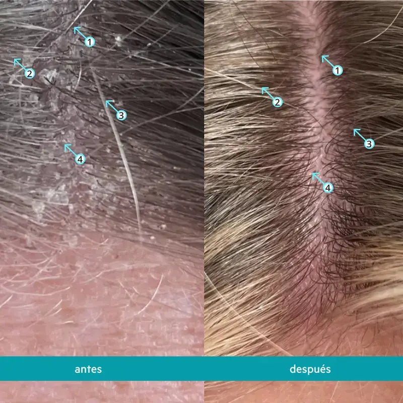 Ds Laboratories Dandrene Anti-Dandruff Exfoliating Shampoo, 205ml