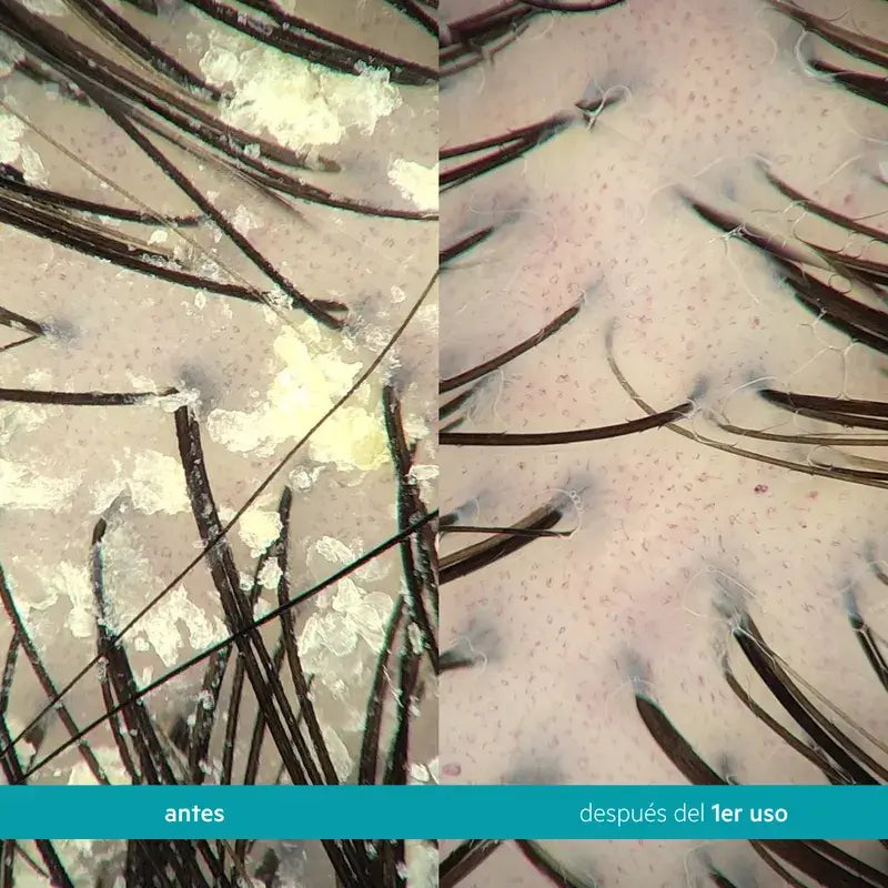 Ds Laboratories Dandrene Anti-Dandruff Exfoliating Shampoo, 205ml