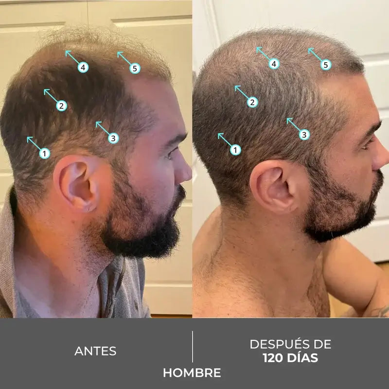 Ds Laboratories Revita Hair Density Stimulating Hair Loss Stimulating Shampoo, 205 ml