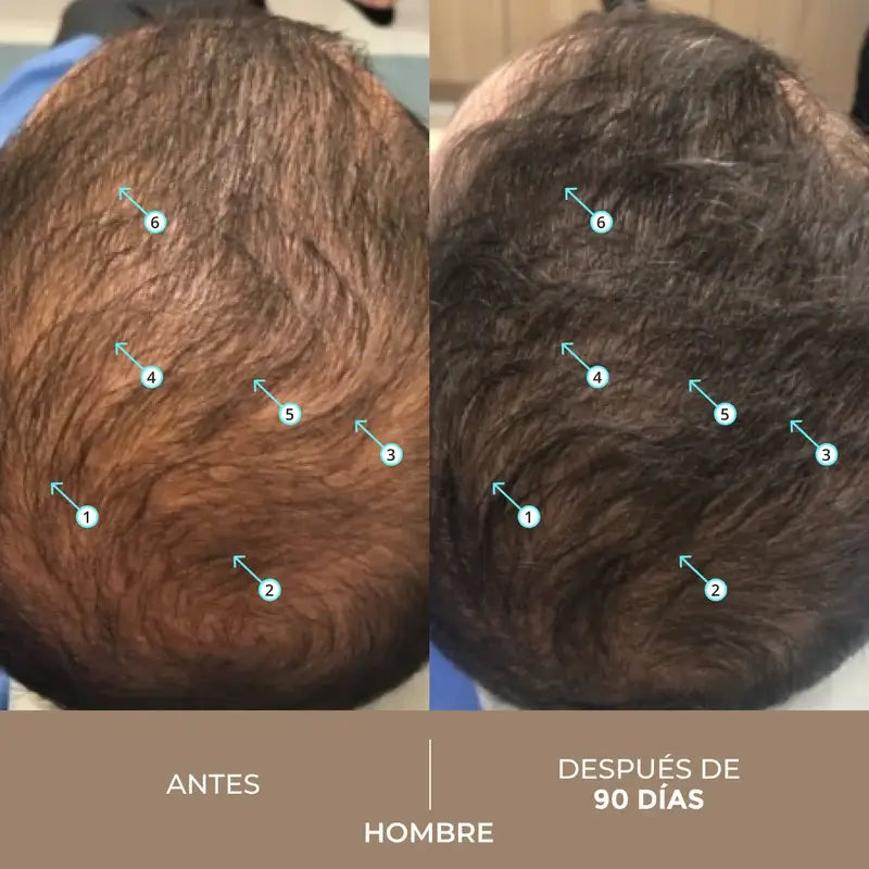 Ds Laboratories Spectral Lotion Dnc-N 3 Months Treatment With Nanoxidil® 5% Hair Loss, 180 ml