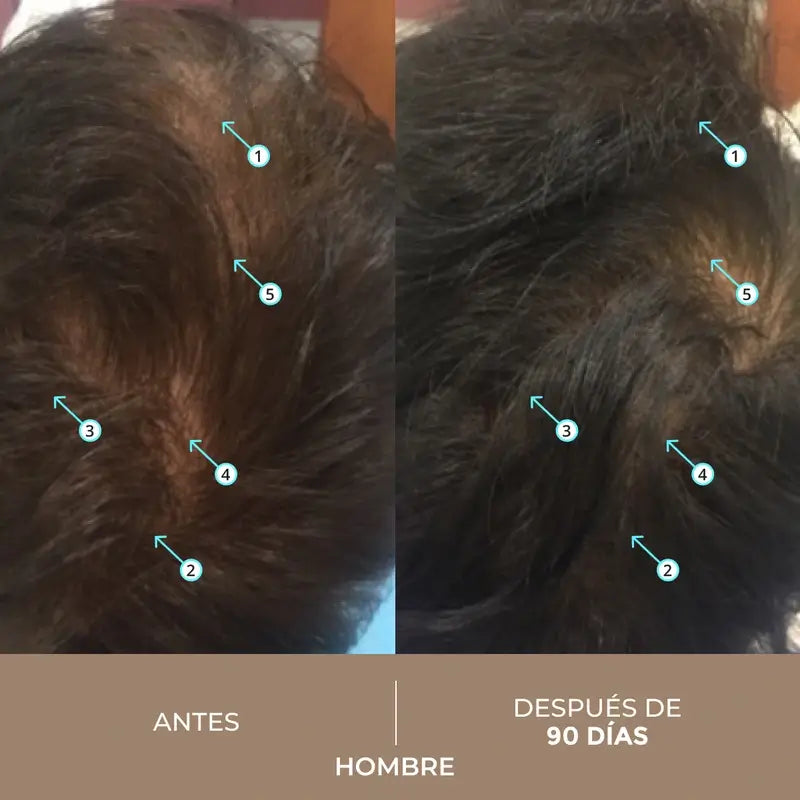 Ds Laboratories Spectral Lotion Spectral Dnc-N Nanoxidil® 5% Hair Loss Treatment, 60 ml