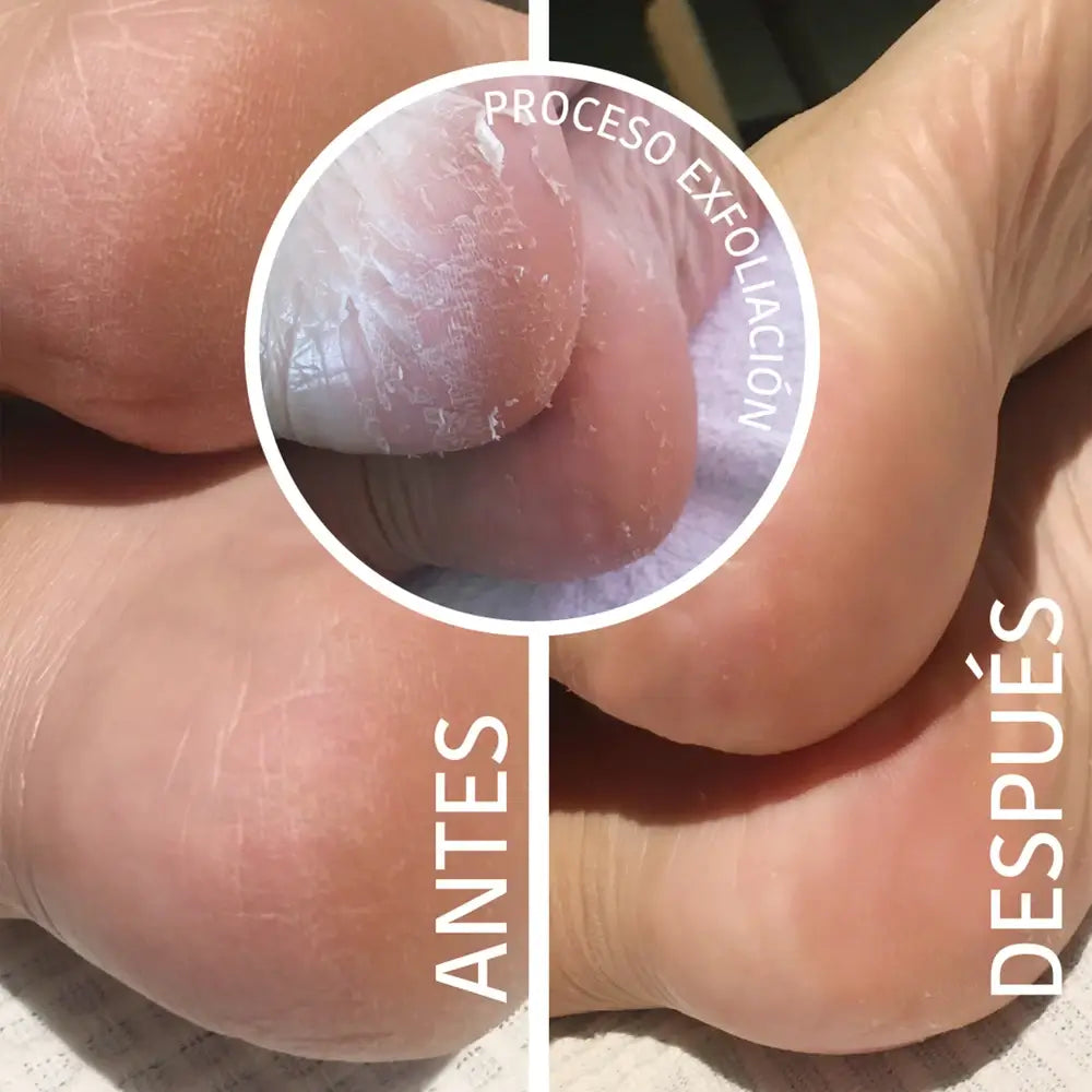 Iroha Nature Corporal Socks Peeling & Exfoliating Mask & Scrub, 20 Ml