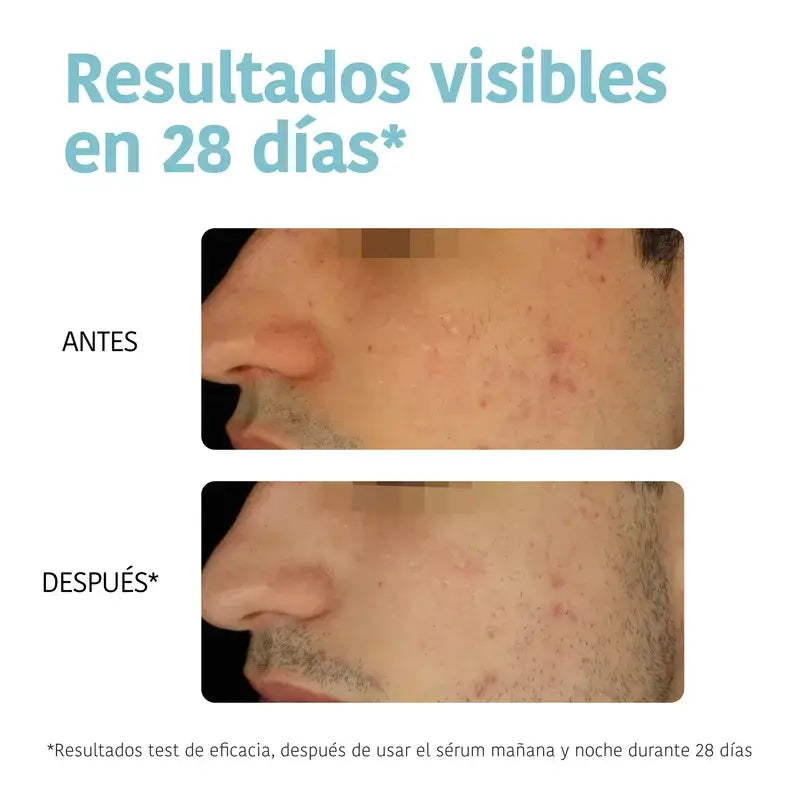 Iroha Nature Oily Skin Anti-Imperfection Serum, 30 ml