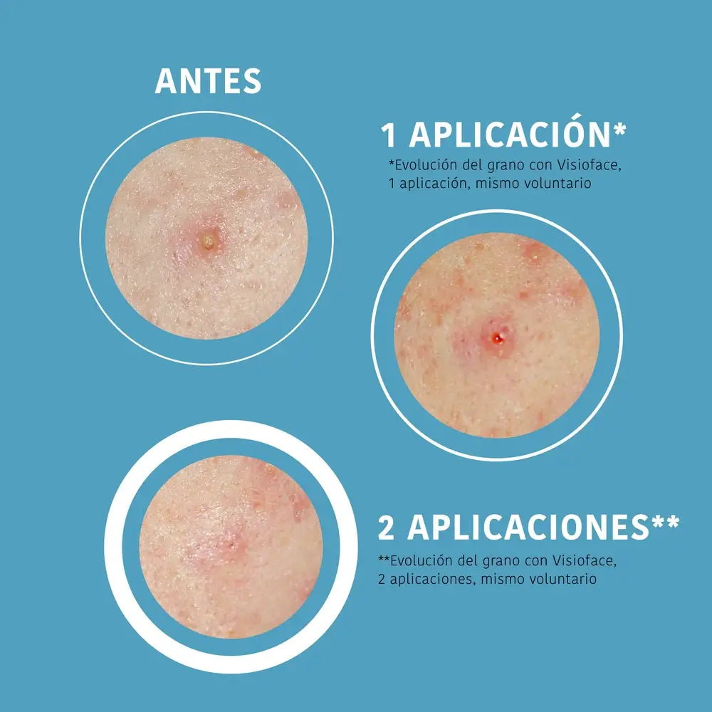 Iroha Nature Sos Pimples Patches - Salicylic Acid, 18 pcs.