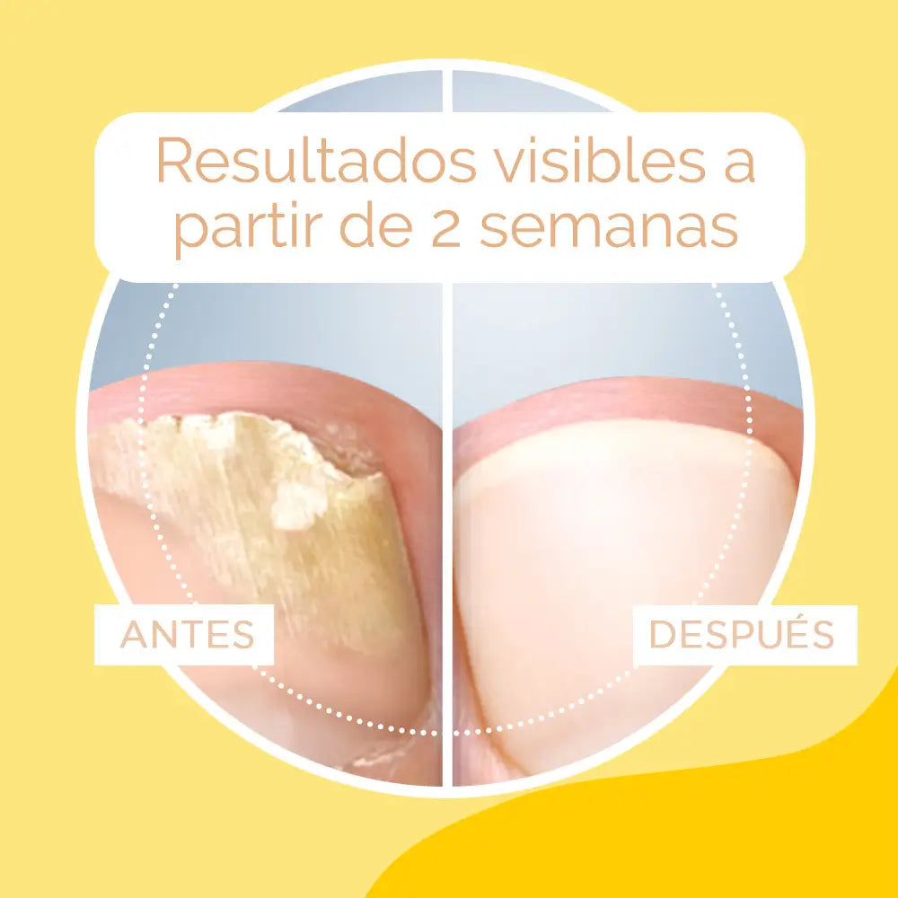 Scholl Anti-Fungal Nail Treatment